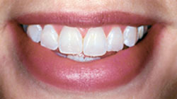 After Whitening