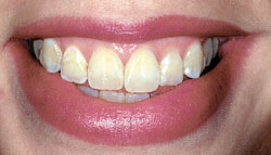 Before Whitening